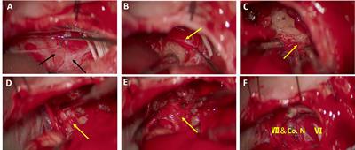 Application of Subperineural Resection Technique in Vestibular Schwannomas: Surgical Efficacy and Outcomes in 124 patients